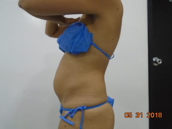 Antes