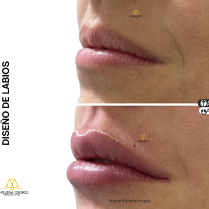 Labios