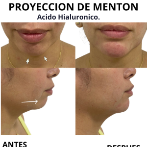 Aumento de mentón 2- a. hialuróncio