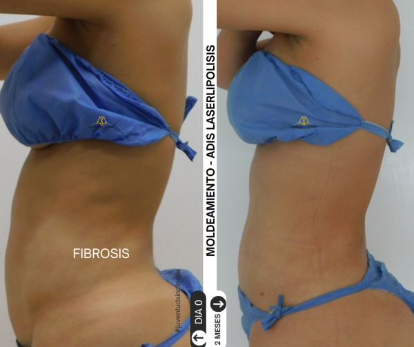 Moldeamiento - fibrosis - adis laserliposlisis