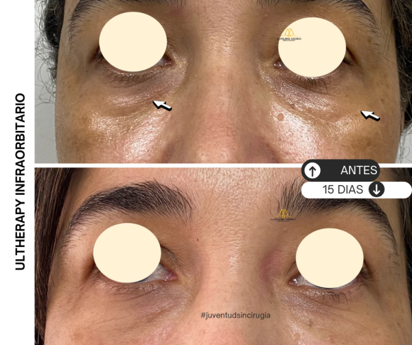 Ultherapy infraorbitario