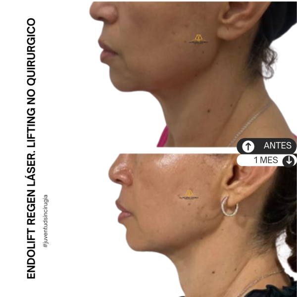 Endolift 2