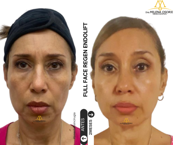 Endolift 3