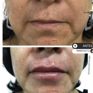 Labios-5