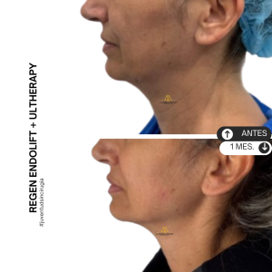 Endolift + Ultherapy