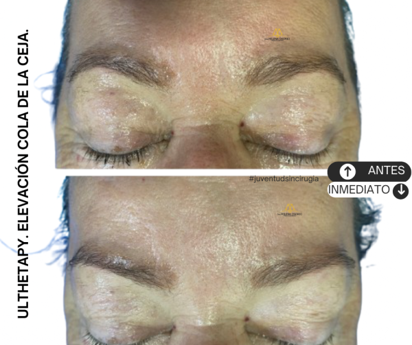 Ultherapy cejas