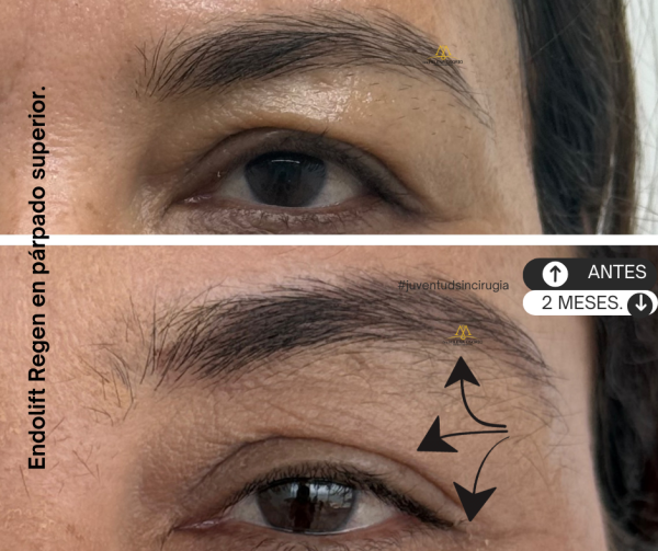 Endolift en parpados