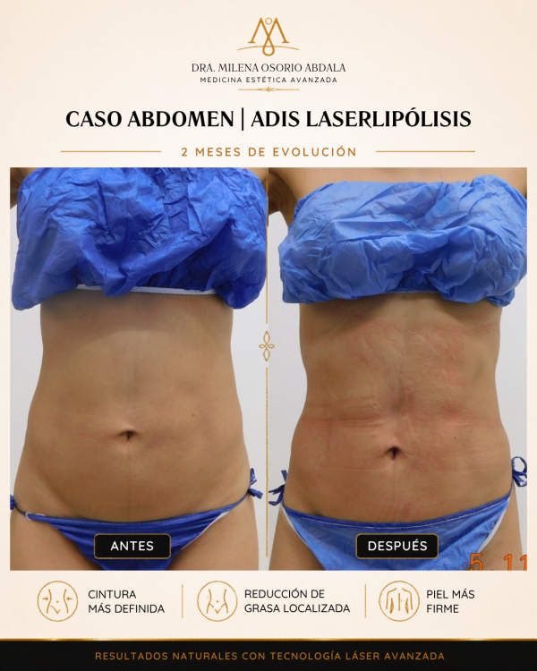 Caso abdomen - adis