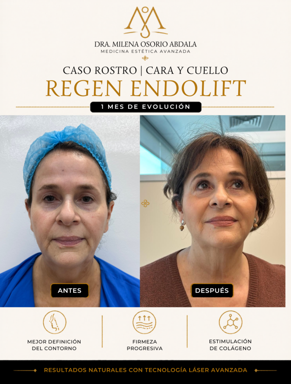 Caso rostro Cuello y Mandíbula
