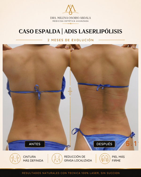 caso espalda