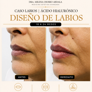 caso labios