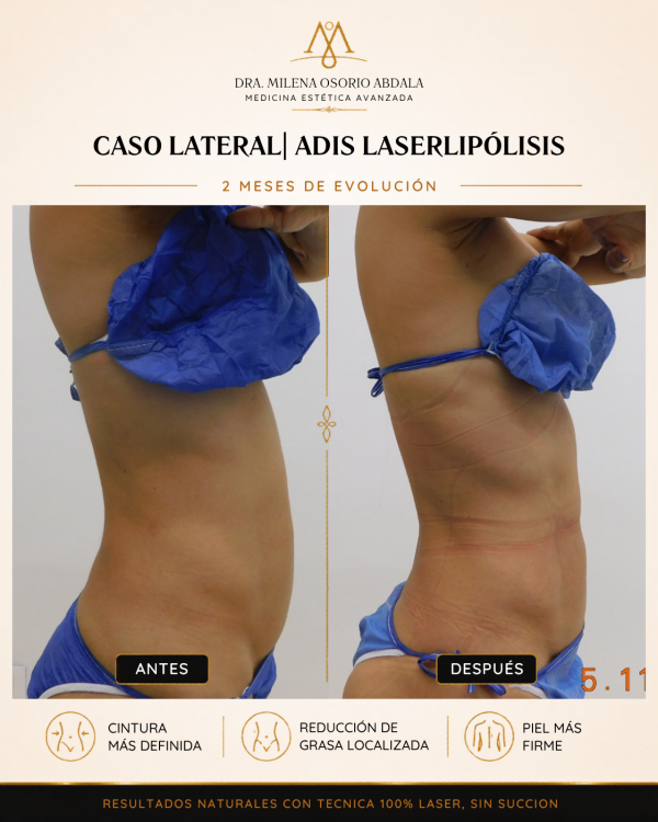 caso lateral