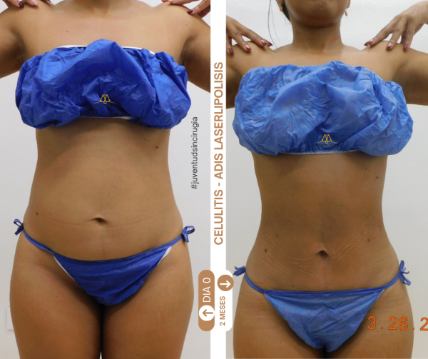 celulitis - adis laserlipolisis