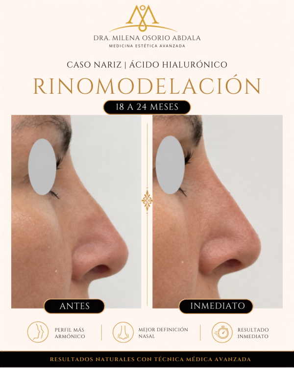 Rinomodelación