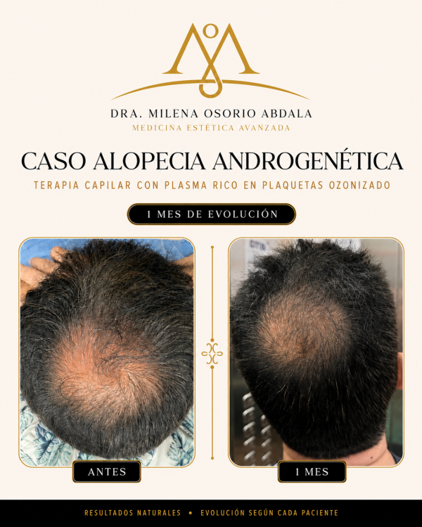 Terapia capilar
