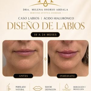Diseño de labios AH