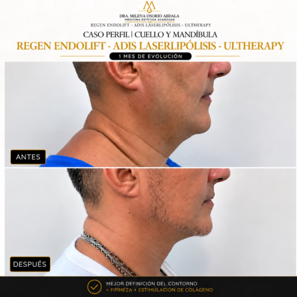 Adis laserlipolisis - endolift - Ultherapy
