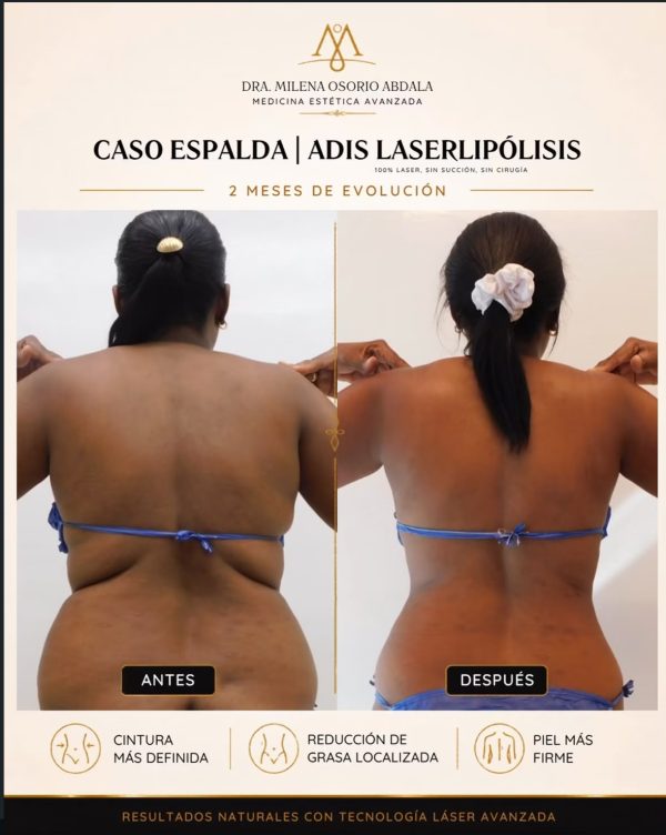 adis laserlipolisis 2