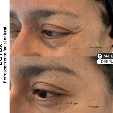 Botox Dra. Milena Osorio